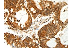 The image on the left is immunohistochemistry of paraffin-embedded Human colon cancer tissue using ABIN7129018(COX7B Antibody) at dilution 1/60, on the right is treated with fusion protein. (COX7B anticorps)