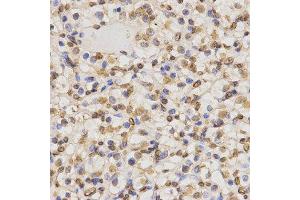 Immunohistochemistry of paraffin-embedded human kidney cancer tissue using H3K36me2 antibody at dilution of 1:200 (x400 lens)