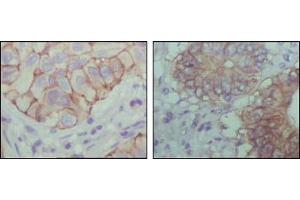 Immunohistochemical analysis of paraffin-embedded human lung cancer (left) and colon cancer (right) showing cytoplasmic localization with DAB staining using EphB1 mouse mAb. (EhpB1 (AA 19-133) anticorps)