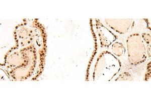 Immunohistochemistry of paraffin-embedded Human thyroid cancer tissue using RMND5B Polyclonal Antibody at dilution of 1:50(x200) (RMND5B anticorps)