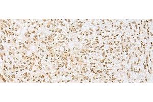Immunohistochemistry of paraffin-embedded Human liver cancer tissue using PNRC2 Polyclonal Antibody at dilution of 1:30(x200) (PNRC2 anticorps)