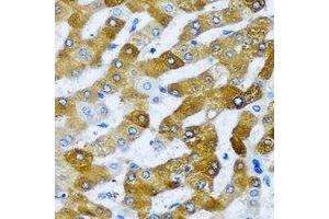 Immunohistochemical analysis of AARS2 staining in human liver cancer formalin fixed paraffin embedded tissue section. (AARS2 anticorps)