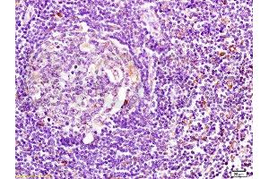 Formalin-fixed human pancreatic cancer tissue labeled with Anti-HLA DMβ Polyclonal Antibody, Unconjugated  at 1:200 followed by conjugation to the secondary antibody and DAB staining