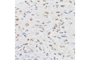 Immunohistochemistry of paraffin-embedded human lung cancer using HMGN1 antibody (ABIN5975005) at dilution of 1/100 (40x lens). (HMGN1 anticorps)