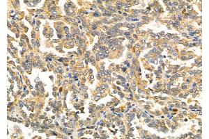 ABIN6257757 and ABIN6275874 at 1/100 staining Human kidney cancer by IHC-P. (LY75/DEC-205 anticorps  (Internal Region))