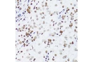 Immunohistochemistry of paraffin-embedded human kidney cancer using NFKB2 Antibody.