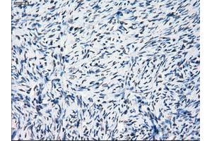 Immunohistochemical staining of paraffin-embedded Adenocarcinoma of breast tissue using anti-PRKY mouse monoclonal antibody. (PRKY anticorps)