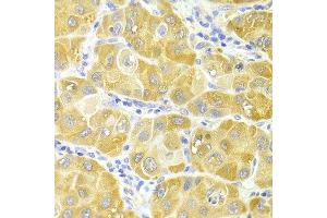 Immunohistochemistry of paraffin-embedded human liver cancer using CYP2E1 antibody at dilution of 1:100 (x400 lens). (CYP2E1 anticorps)