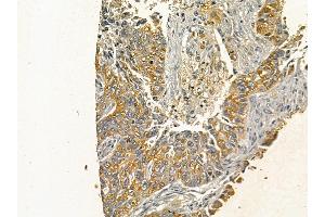 Cytokeratin 13 Mouse Monoclonal Antibody at 1/100 staining human lung cancer by IHC-P.