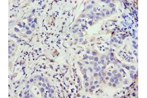 Immunohistochemistry of paraffin-embedded human bladder cancer using ABIN7176493 at dilution of 1:100 (ZNF643 anticorps  (AA 15-310))