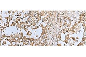 Immunohistochemistry of paraffin-embedded Human colorectal cancer tissue using TREM1 Polyclonal Antibody at dilution of 1:50(x200) (TREM1 anticorps)