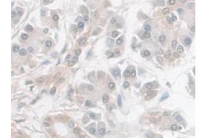 Detection of NSE in Human Pancreatic cancer Tissue using Monoclonal Antibody to Enolase, Neuron Specific (NSE)