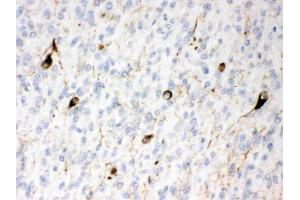 Alpha Internexin was detected in paraffin-embedded sections of human glioma tissues using rabbit anti- Alpha Internexin Antigen Affinity purified polyclonal antibody (Catalog # ) at 1 µg/mL. (INA anticorps  (AA 71-161))