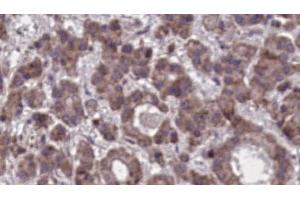 ABIN6273905 at 1/100 staining Human liver cancer tissue by IHC-P. (GPR97 anticorps  (N-Term))