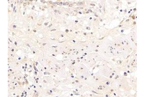 Detection of AR in Human Endometrial cancer Tissue using Polyclonal Antibody to Androgen Receptor (AR)