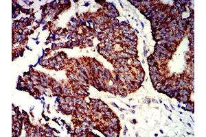 Immunohistochemical analysis of paraffin-embedded rectum cancer tissues using P2RY1 mouse mAb with DAB staining. (P2RY1 anticorps)