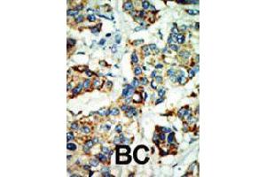 Formalin-fixed and paraffin-embedded human cancer tissue reacted with NEK4 polyclonal antibody  , which was peroxidase-conjugated to the secondary antibody, followed by AEC staining. (NEK4 anticorps  (C-Term))