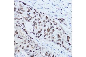 Immunohistochemistry of paraffin-embedded human breast cancer using SSB Rabbit pAb (ABIN3015264, ABIN3015265, ABIN3015266 and ABIN6213909) at dilution of 1:300 (40x lens).
