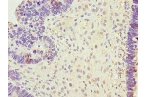 Immunohistochemistry of paraffin-embedded human ovarian cancer using ABIN7168591 at dilution of 1:100 (SAP30BP anticorps  (AA 1-308))