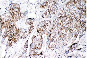 Anti-VE Cadherin antibody, IHC(P) IHC(P): Human Lung Cancer Tissue (Cadherin 5 anticorps  (C-Term))