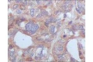 Immunohistochemistry (IHC) image for anti-serine/threonine/tyrosine Kinase 1 (STYK1) (truncated) antibody (ABIN2464109)