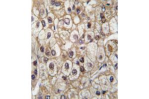 Formalin-fixed and paraffin-embedded human hepatocarcinoma tissue reacted with CYP2C9 antibody (Center), which was peroxidase-conjugated to the secondary antibody, followed by DAB staining. (CYP2C9 anticorps  (AA 235-265))