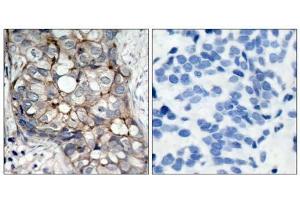 Immunohistochemical analysis of paraffin- embedded human breast carcinoma tissue using (EGFR anticorps)