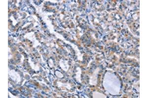 The image on the left is immunohistochemistry of paraffin-embedded Human thyroid cancer tissue using (LRRK2 Antibody) at dilution 1/20, on the right is treated with fusion protein. (LRRK2 anticorps)