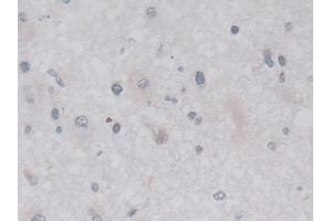 Detection of LACTb in Human Glioma Tissue using Polyclonal Antibody to Lactamase Beta (LACTb)