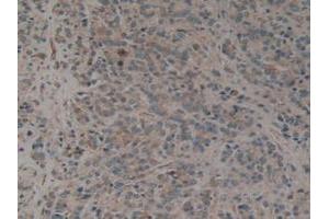 IHC-P analysis of Human Prostate Gland Cancer Tissue, with DAB staining. (CALU anticorps  (AA 20-315))