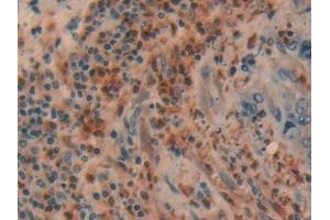 Detection of UCHL1 in Human Liver cancer Tissue using Polyclonal Antibody to Ubiquitin Carboxyl Terminal Hydrolase L1 (UCHL1)