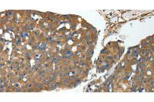 Immunohistochemistry of paraffin-embedded Human breast cancer using MSN Polyclonal Antibody at dilution of 1:30