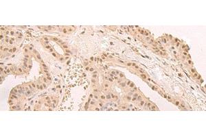 Immunohistochemistry of paraffin-embedded Human thyroid cancer tissue using CNOT10 Polyclonal Antibody at dilution of 1:50(x200) (CNOT10 anticorps)