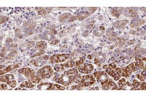 ABIN6272371 at 1/100 staining Human liver cancer tissue by IHC-P. (OR2C3 anticorps)