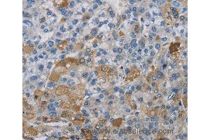 Immunohistochemistry of Human liver cancer using DNAJB4 Polyclonal Antibody at dilution of 1:50 (DNAJB4 anticorps)