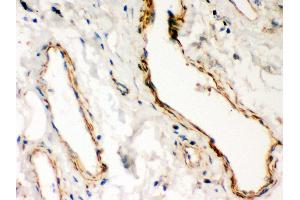 Anti- Dystrophin Picoband antibody, IHC(P) IHC(P): Human Lung Cancer Tissue (Dystrophin anticorps  (AA 3076-3404))