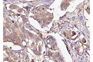 ABIN6269037 at 1/100 staining Human breast cancer tissue by IHC-P. (EPH Receptor A4 anticorps  (Internal Region))