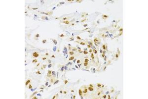Immunohistochemistry of paraffin-embedded human breast cancer using HNRNPA1 Antibody (ABIN5975570) at dilution of 1/100 (40x lens). (HNRNPA1 anticorps)