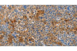Immunohistochemistry of paraffin-embedded Human liver cancer tissue using HTRA3 Polyclonal Antibody at dilution 1:45 (HTRA3 anticorps)
