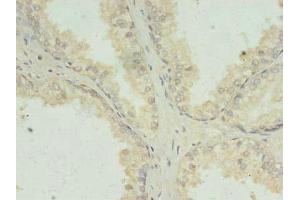 Immunohistochemistry of paraffin-embedded human prostate cancer using ABIN7156699 at dilution of 1:100