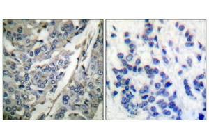 Immunohistochemical analysis of paraffin-embedded human breast carcinoma tissue using Synaptotagmin (phospho-Thr202) antibody (left)or the same antibody preincubated with blocking peptide (right).