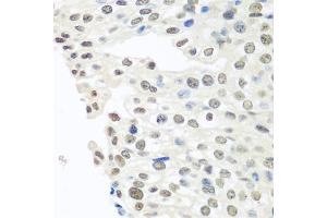 Immunohistochemistry of paraffin-embedded human prostate cancer using TARDBP antibody. (TARDBP anticorps)
