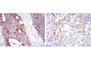 Immunohistochemical analysis of paraffin-embedded rectum cancer tissues (left) and lung cancer tissues (right) using KRT19 mouse mAb with DAB staining. (Cytokeratin 19 anticorps)
