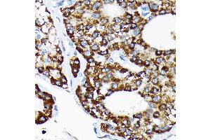 Immunohistochemistry of paraffin-embedded human liver cancer using HSP Rabbit mAb (ABIN7267580) at dilution of 1:100 (40x lens).