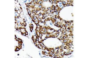 Immunohistochemistry of paraffin-embedded human liver cancer using HSP Rabbit mAb (ABIN7267580) at dilution of 1:100 (40x lens). (HSPA4 anticorps)