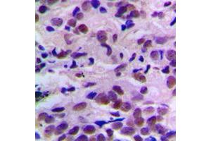Immunohistochemical analysis of CDK2 (pT160) staining in human breast cancer formalin fixed paraffin embedded tissue section. (CDK2 anticorps  (pSer160))