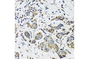 Immunohistochemistry of paraffin-embedded human breast cancer using SSBP1 antibody (ABIN5974202) at dilution of 1/100 (40x lens). (SSBP1 anticorps)