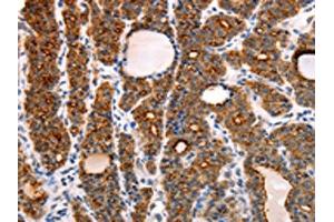 The image on the left is immunohistochemistry of paraffin-embedded Human thyroid cancer tissue using ABIN7130808(RAMP1 Antibody) at dilution 1/10, on the right is treated with fusion protein. (RAMP1 anticorps)