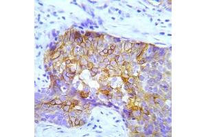 Immunohistochemical analysis of paraffin-embedded human lung adenocarcinoma tissue using Crk2 (Phospho-Try221) Antibody (E012070). (CDK6 anticorps  (pTry221))