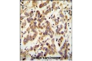 C antibody (Center) (ABIN654782 and ABIN2844463) immunohistochemistry analysis in formalin fixed and paraffin embedded human testis carcinoma followed by peroxidase conjugation of the secondary antibody and DAB staining. (C20ORF173 anticorps  (AA 48-76))
